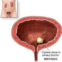 膀胱结石会有哪些特殊表现？