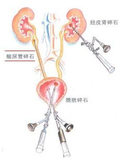 治疗输尿管结石的两种手术